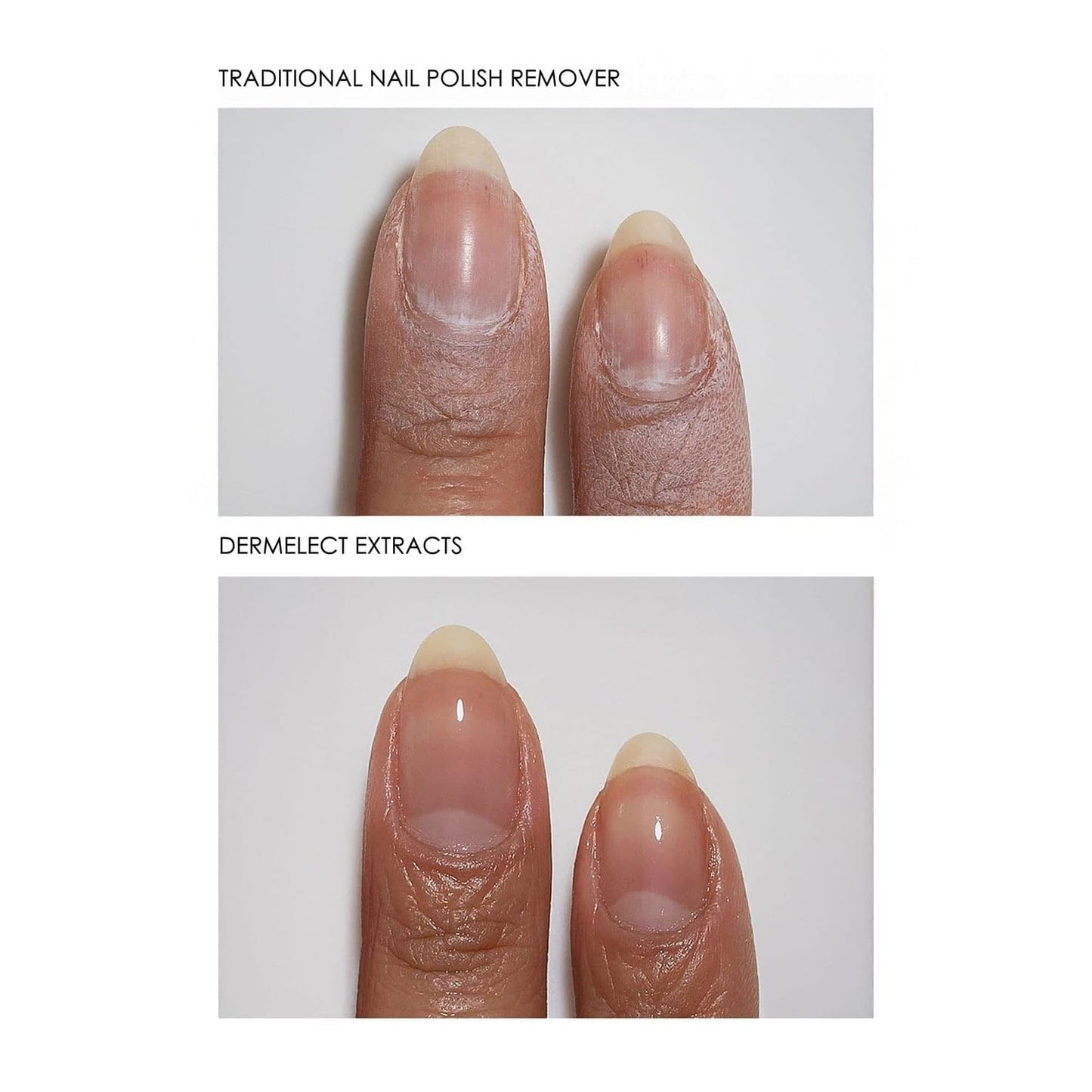 Dermelect Clean & Care Nail Renewal Kit – Nailcare Treatment Set with Ridge Filler, Nail Brightener & Polish Remover Wipes – Strengthens, Brightens