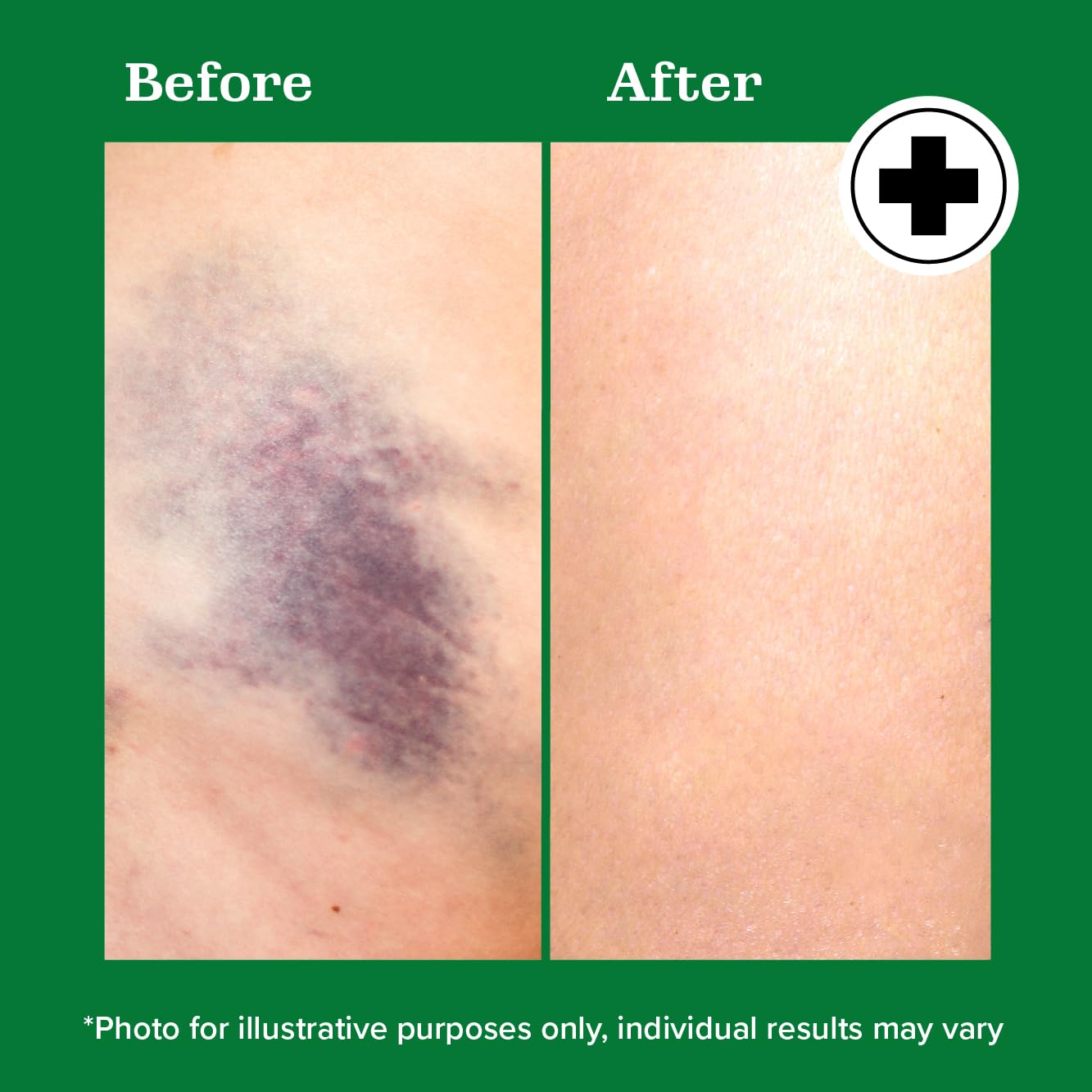 Miracle Plus Arnica Bruise Relief Gel + Magnesium Leg Relief Cream Bundle Miracle PlusBuy Supplements Australia
