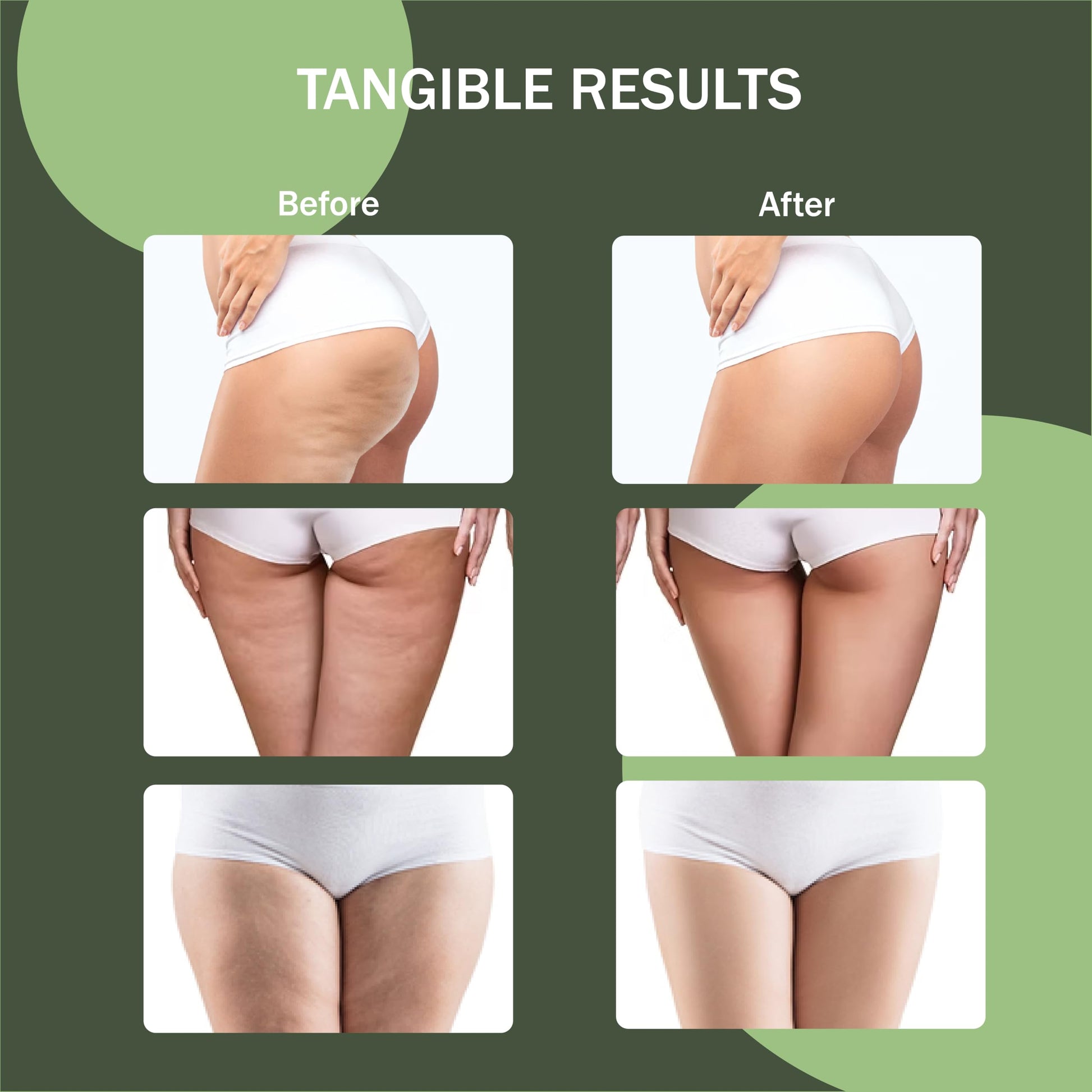 Osmibe Cellulite Manual Massager - Lymphatic Drainage Massager with Detachable Handles - Reduce Cellulite and Stretch Marks on Legs and Body Osmibe buy supplements Au