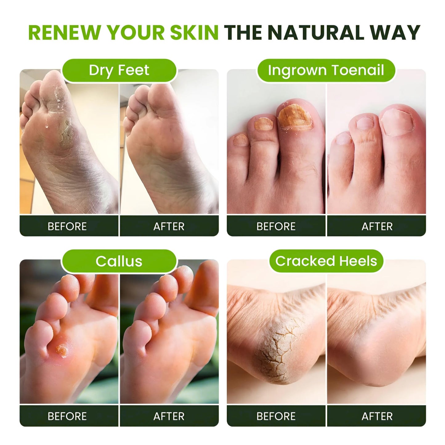 FOOT CURE Tea Tree Oil Foot Soak with Epsom Salt - Best Toenail Fungus Treatment, Athletes Foot & Softens Calluses - Soothes Sore & Tired Feet, Fungal Toe, Foot Odor Scent, Spa Pedicure (Pack of 2) FOOT CURE buy supplements Au