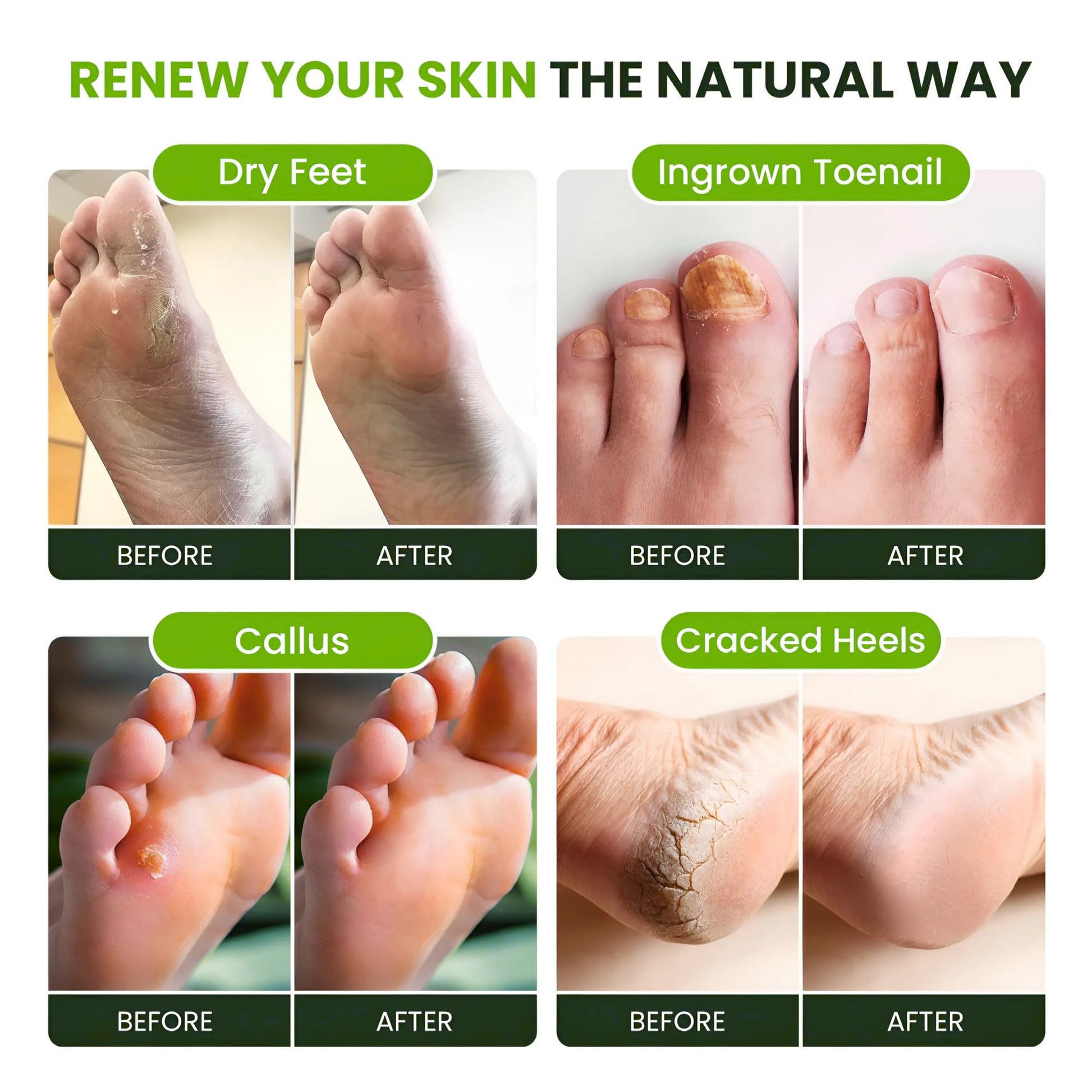 FOOT CURE Tea Tree Oil Foot Soak with Epsom Salt - Best Toenail Fungus Treatment, Athletes Foot & Softens Calluses - Soothes Sore & Tired Feet, Fungal Toe, Foot Odor Scent, Spa Pedicure (Pack of 2) FOOT CURE buy supplements Au