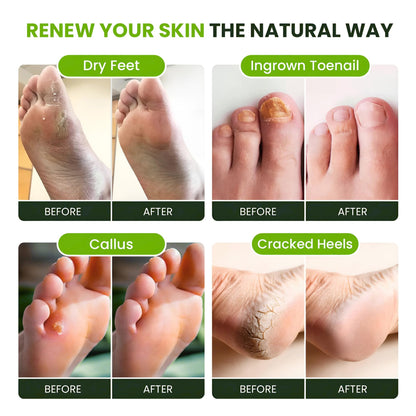 FOOT CURE Tea Tree Oil Foot Soak with Epsom Salt - Best Toenail Fungus Treatment, Athletes Foot & Softens Calluses - Soothes Sore & Tired Feet, Fungal Toe, Foot Odor Scent, Spa Pedicure (Pack of 2) FOOT CURE buy supplements Au