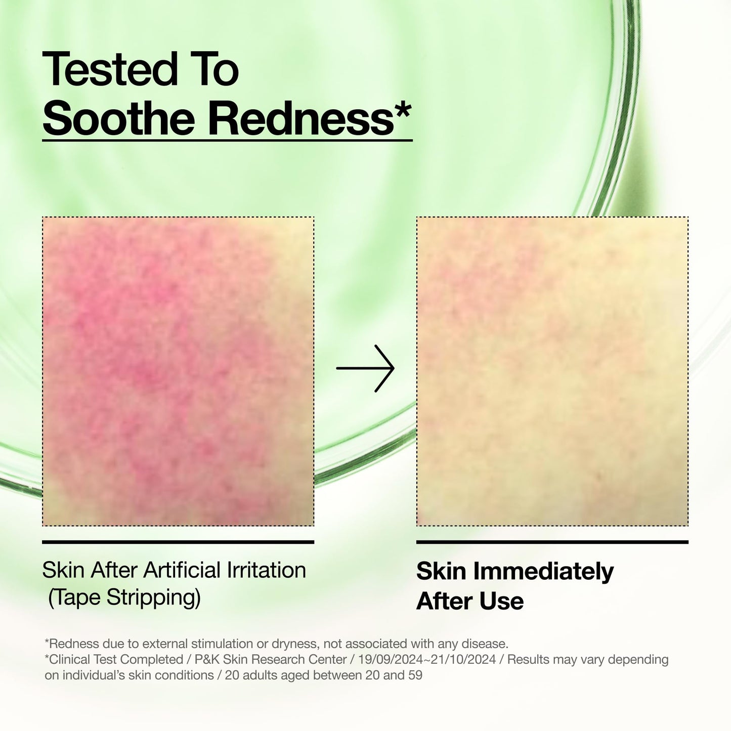 Anua Azelaic Acid 10 Hyaluron Redness Soothing Serum, Facial Serum for Blemish-Prone & Oily-Prone Skin