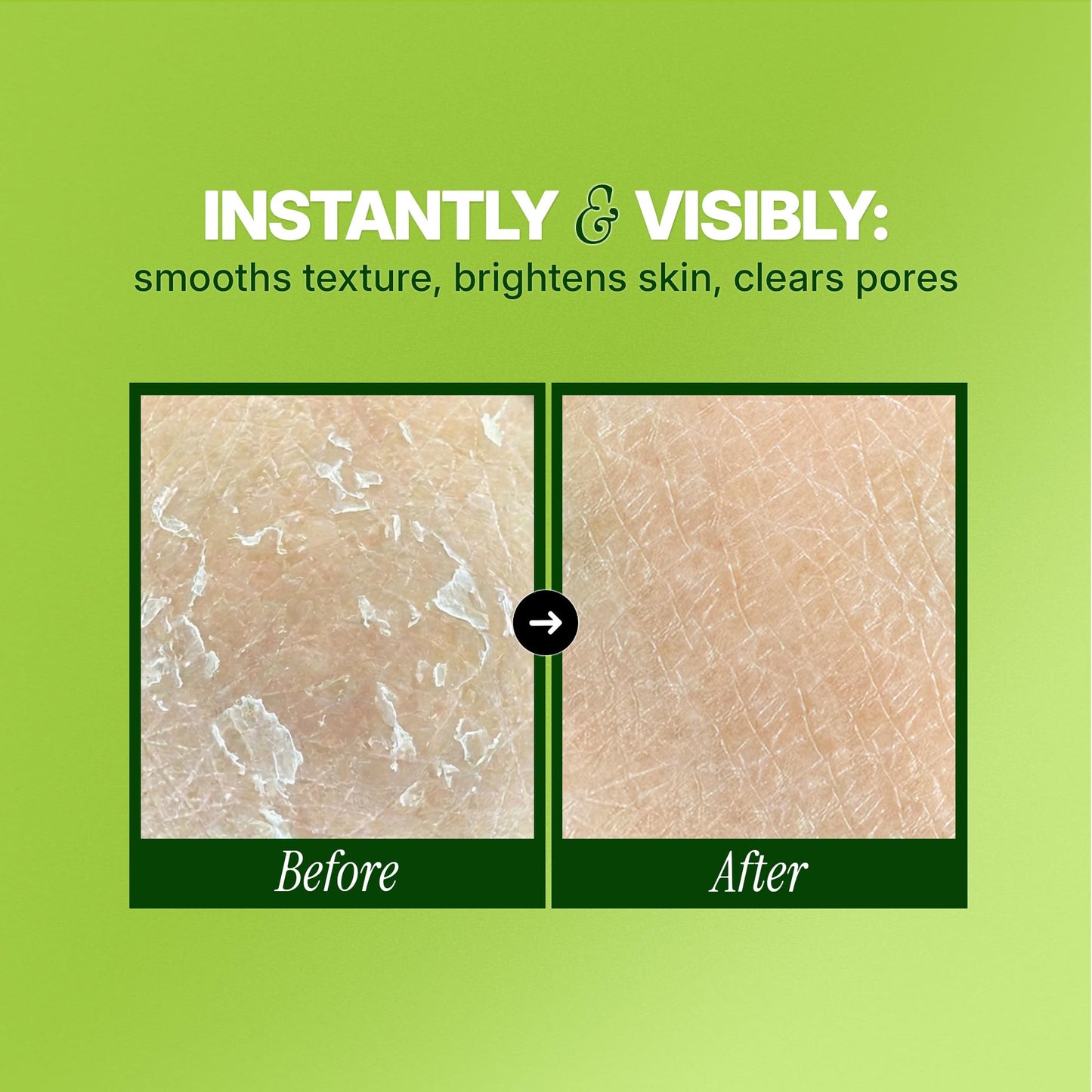 Ebanel Chemical Peel for Face, AHA BHA Exfoliator, Glycolic Acid Peel, Salicylic & Lactic Acid Face Peeling Gel, Infused with Green Tea & Chamomile for Acne Scars, Dark Spots, Wrinkles, Fine Lines