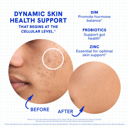 Clear Skin Supplement with Zinc, DIM & Probiotics | 3-in-1 Balance, Glow & Health Skin Support | Triple Action Hyaluronic Acid, Niaciminide & Vitamins for Hormone, Complexion & Gut Support | 180 Ct SMNutritionBuy Supplements Australia