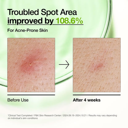Anua Azelaic Acid 10 Hyaluron Redness Soothing Serum, Facial Serum for Blemish-Prone & Oily-Prone Skin