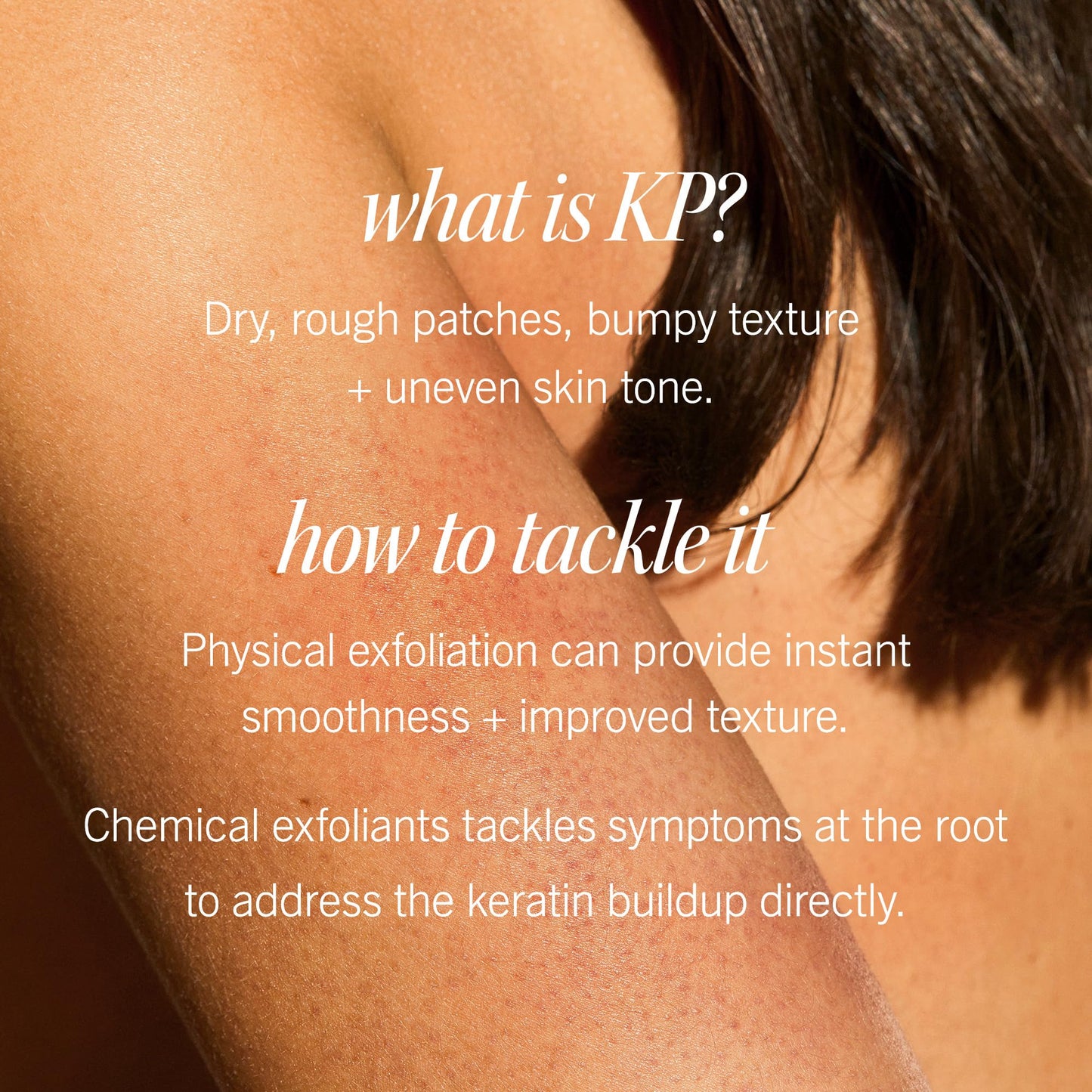 First Aid Beauty - KP Bump Eraser Body Scrub with 10% AHA, Keratosis Pilaris Exfoliator with Glycolic and Lactic acids, Helps Reduce Chicken Skin Bumps