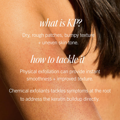 First Aid Beauty - KP Bump Eraser Body Scrub with 10% AHA, Keratosis Pilaris Exfoliator with Glycolic and Lactic acids, Helps Reduce Chicken Skin Bumps
